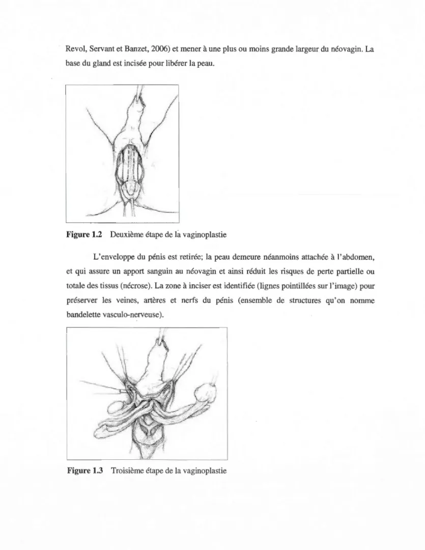 Figure 1.3  Troisième étape de la vaginoplastie 