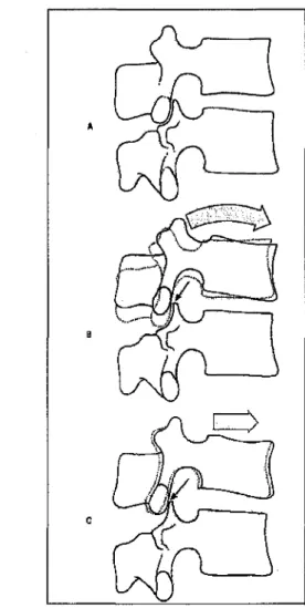 Figure  3 : Les composantes du mouvement de flexion a une articulation  intervertebrale