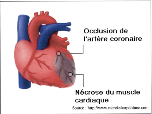 Figure 1  :  Zone détruite suite à un infarctus