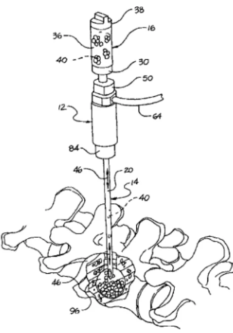Figure 2.10 Device for inserting fill material particles into body cavities [Kuslich et al.,  2003]