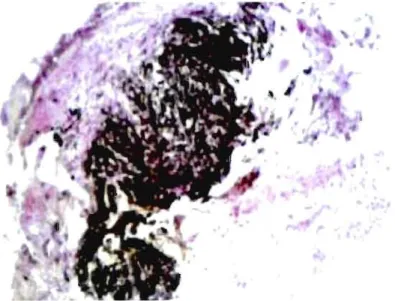 Figure 0.4.  Aspect histologique d'un nodule fibro-hyalin caractéristique de  la  silicose(Anthoine et Humbert 2007)