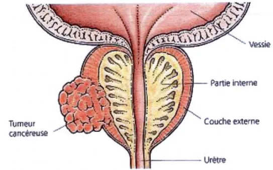 Figure 1.1  Tumeur  cancéreuse  dans  la  partie  externe  de  la  prostate  (Kirk  et  Smith , 2007)