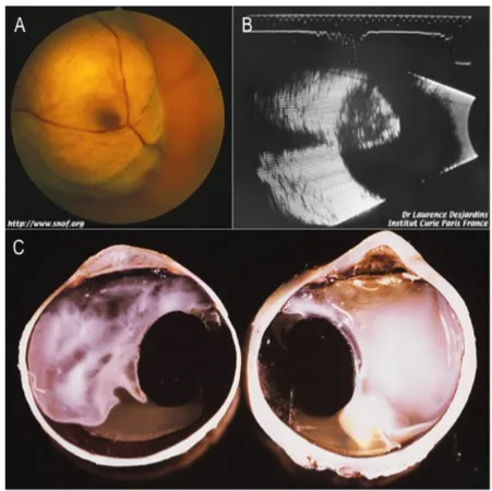 Figure  1.4.  Aspect  macroscopique  du  mélanome  uvéal.  A.  Vue  du  fond  d’œil  démontrant  un  mélanome  choroïdien envahissant et comprimant la macula