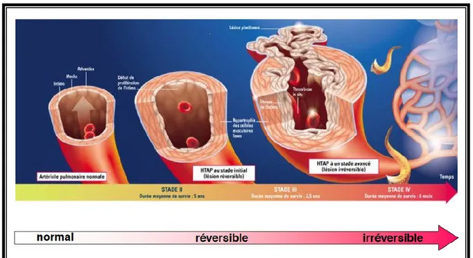 Figure 1- 8 : Atteinte évolutive de la paroi des artères pulmonaires. Humbert. 