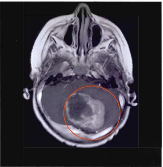 Figure 3 : Médulloblastome en  IRM 