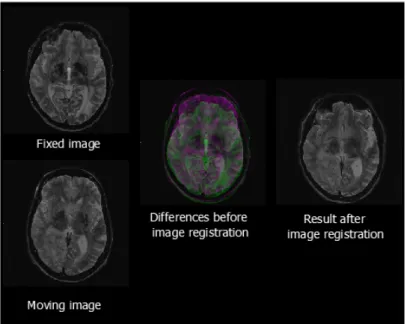 Figure 2.3.2: Axial slices of two T2-w MR images before and after deformable image registra- registra-tion.