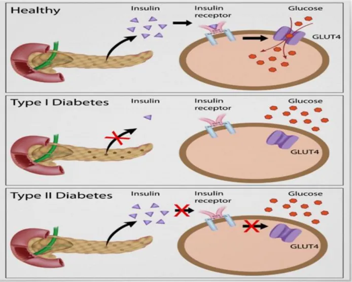 Fig. 10 : Insulin action and diabetes type1 and 2 (http://science-tuition.co.uk/diabetes/)