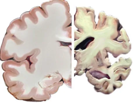 Figure 3. Illustration de l’atrophie cérébrale dans la MA au stade avancé. 
