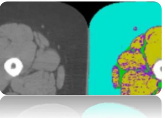 Figure 11 : Segmentation de l’image de la mi-cuisse obtenue par le logiciel suite à la  tomodensitométrie 