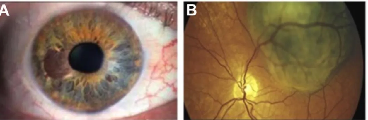 Figure 1.6: Apparences cliniques du mélanome uvéal .  Mélanome de l’iris (A). Mélanome de la  choroïde (B)