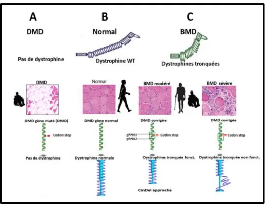 Figure 4: Correction du gène DMD muté et les types des dystrophines tronquées 
