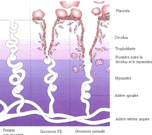 Figure  1.2  Schématisation  de  l'invasion  trophoblastique  et  du  remodelage  des  artères  spiralées  lors  d'une  grossesse  PE  comparativement  à  une  grossesse normale