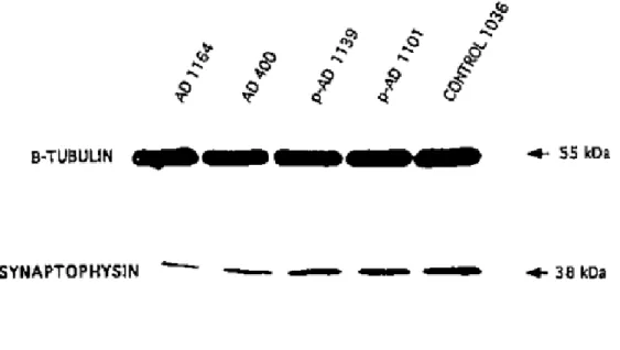 Figure 15 : Diminution de Synaptophysine dans la maladie d’Alzheimer.  