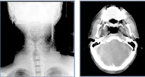 Figure 1.13: Visualisation de la qualité image d’un patient traité au niveau de la tête et du cou avec l'imagerie kV (à  gauche) et le CBCT (à droite)