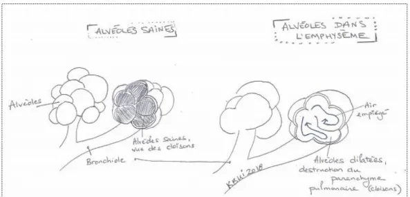 Figure 4 : Illustration libre d’alvéoles saines et  d’alvéoles dans l’emphysème  