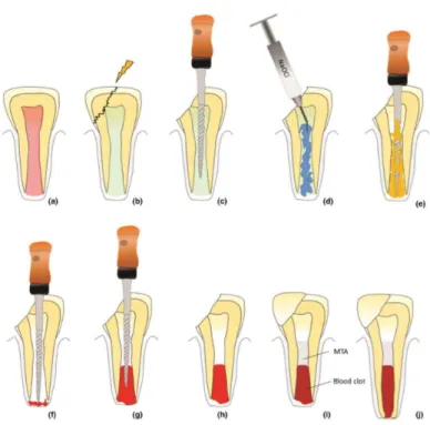 Figure  3.  Schéma  explicatif  des  étapes  de  la  revascularisation.  [Tiré  de  Conde  et  coll.(43)]