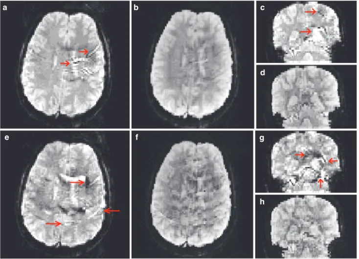 Fig. 5 Axial (images a, b, e and f) and Coronal (c, d, g and h) reconstructed slices using mSENSE and 4D-UWR-SENSE for R ¼ 2 and R ¼ 4 with 2  2 mm 2 in-plane spatial resolution
