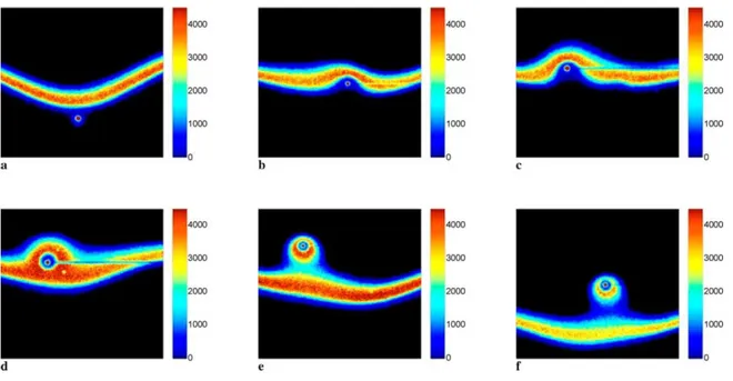 Figure 14: Inflammation d'une gouttelette traversant une flamme caractérisée par PLIF OH 