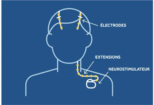 Figure 10 : Illustration du système de stimulation cérébrale profonde (Source Medtronic®)  (47) 