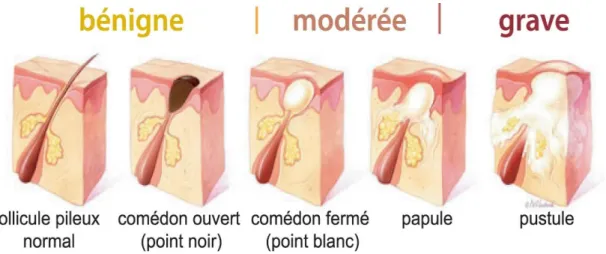 Figure 2 : Schémas représentant les différentes lésions de l’acné [15]