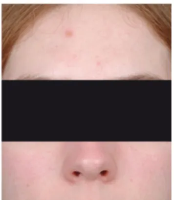 Figure 6 : Photo d'une patiente acnéique au grade 1 du GEA [18]