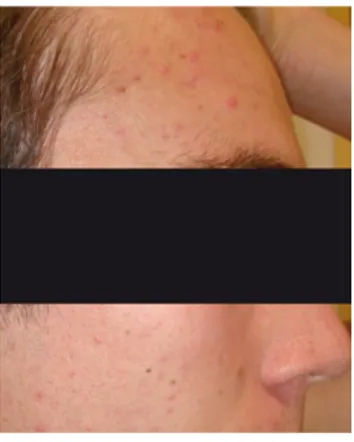 Figure 7 : Photo d'un patient acnéique au grade 2 du GEA [18]