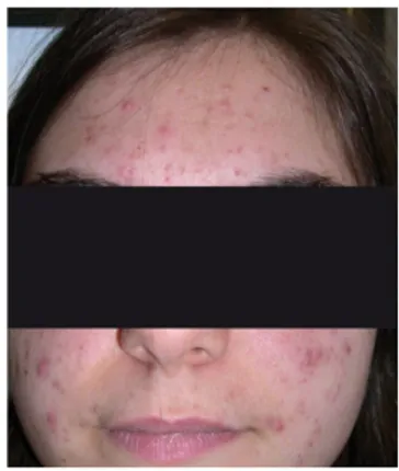 Figure 8 : Photo d'une patiente acnéique au grade 3 du GEA [18]