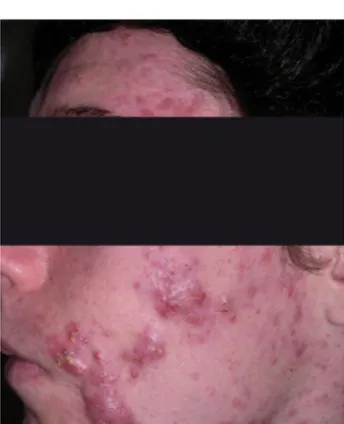 Figure 10 : Photo d'un patient acnéique au grade 5 du GEA [18]