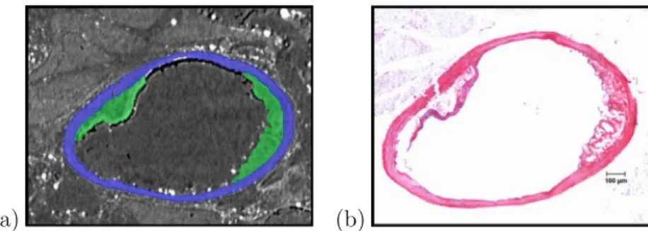Fig. 2. Sections of the three-dimensional geometry. (a) Image obtained by l -CT, the blue color corresponds to the artery wall, the green to the plaque