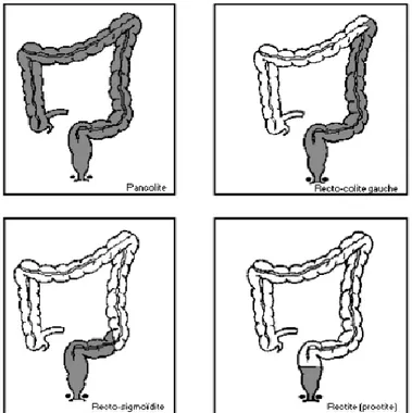 Figure 1 : Localisation et terminologie des atteintes digestives de la RCH  (Source de l’image : Hepatoweb.com) (4)