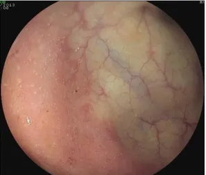 Figure 5 : Limite nette entre muqueuse saine (à droite) et muqueuse pathologique (à  gauche) : érythème et disparition de la trame vasculaire dans la RCH (25)