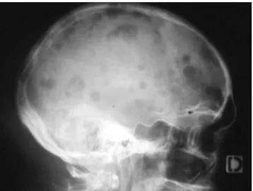 Figure 1  : lacunes multiples à l' ”emporte-pièce&#34; du crâne observées en radiographie (15) 