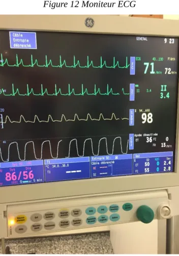 Figure 12 Moniteur ECG 