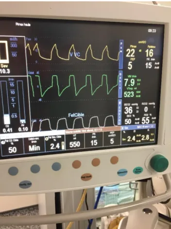 Figure 13 Moniteur de profondeur d'anesthésie 