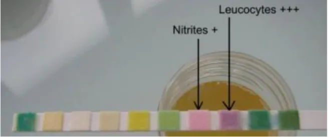 Figure 7 : BU positive aux nitrites (témoin d’une bactériurie) et aux leucocytes [35]