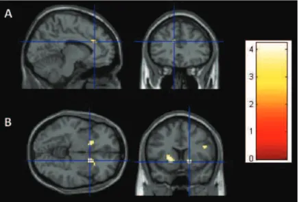 Figure 7. Effects of high vs. low uncertainty during neutral incentive, activity in the dorsal ACC (survived SVC,  p < 0.05 FWE)