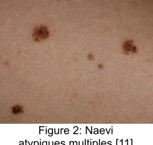 Figure 2: Naevi atypiques multiples [11]