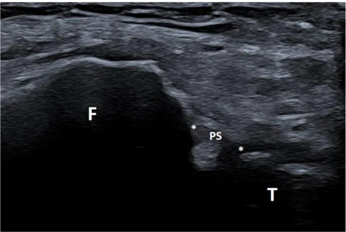 Figure 10 : Faisceau supérieur du ligament TFP postérieur (PS) et ses insertions  (étoiles) en coupe sagittale