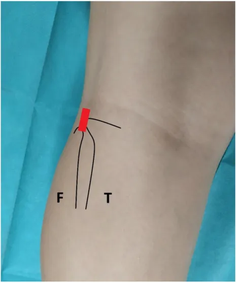 Figure 11 : Positionnement de la sonde en coupe sagittale entre la fibula (F) et le tibia  (T) pour la visualisation du faisceau postéro-supérieur