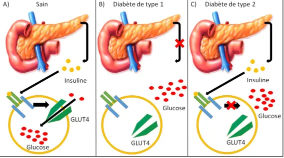 Figure 2 : La régulation du glucose chez une personne saine ainsi que chez les  diabétiques de type 1 et 2