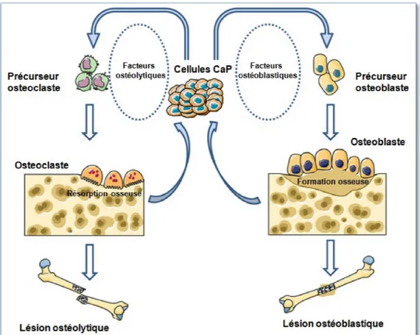 Figure 4: Représentation très simplifiée du développement de métastases osseuses dans le  cancer de la prostate