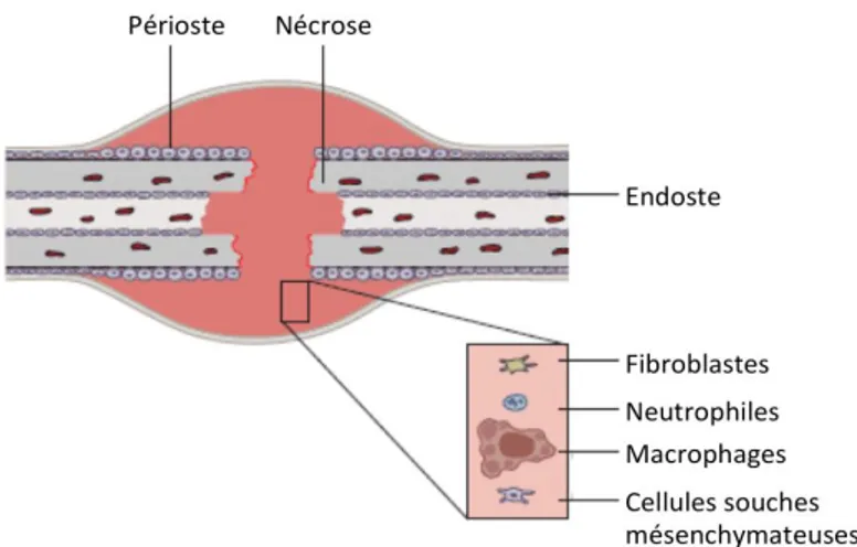 Figure 3 : phase inflammatoire de la cicatrisation osseuse secondaire, d’après Ruedi et al