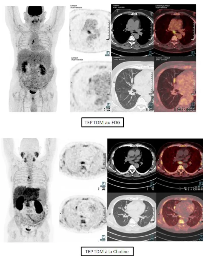 Figure  5  :  Exemple  de  lésion  tumorale  primitive  pulmonaire  avec  adénopathies  médiastinales  mises  en  évidence  à  l'issu  du  TEP  TDM  FDG  et  Choline  chez  un  des  patients de l'étude  