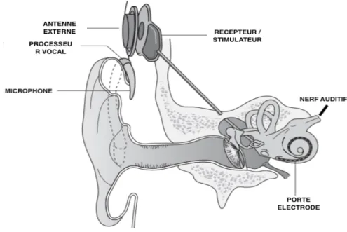 Figure 3 : implant cochléaire (13) 