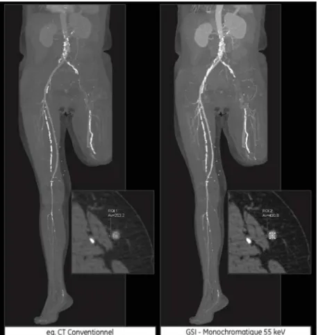 Figure 7 Exploration vasculaire des membres inférieurs, avec et sans imagerie spectrale 