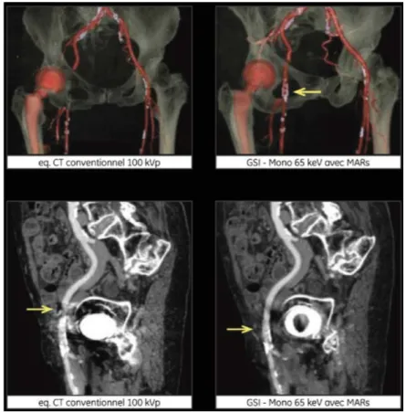 Figure 10 Exploration vasculaire dans le cadre d'une pose de valve aortique 