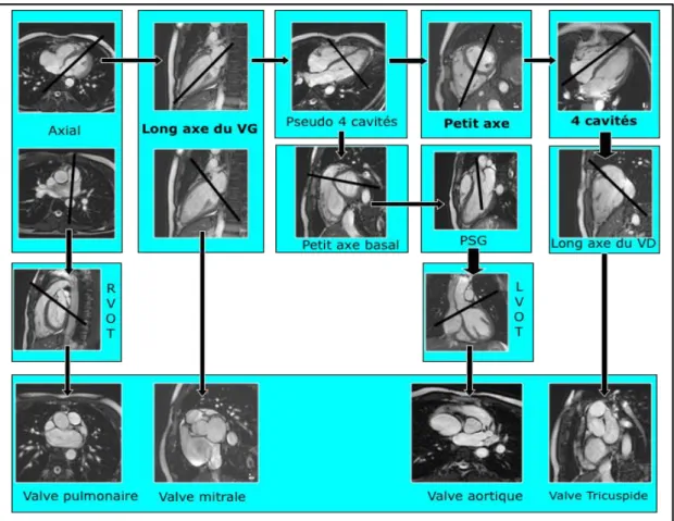 Figure 7: Construction des plans cardiaques en IRM. 
