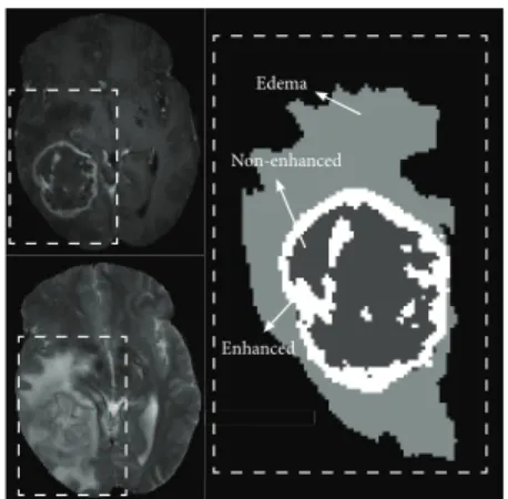 Figure 5.1 – Left: T1C and T2 modal- modal-ity. Right: groundtruth tumor  segmenta-tion.