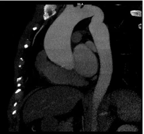 Fig. 5 : Bicuspidie aortique (type L-R) avec anévrysme de l’aorte ascendante et  pseudo-coarctation  