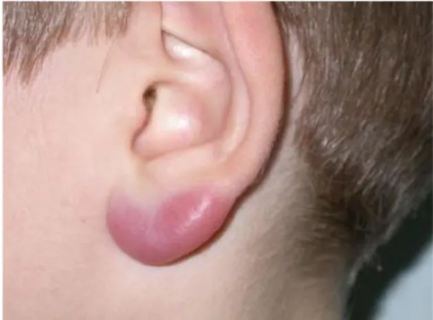 Fig. 9 : Lymphocytome borrélien du lobe de l’oreille  Source : Palmen C. et al., 2010